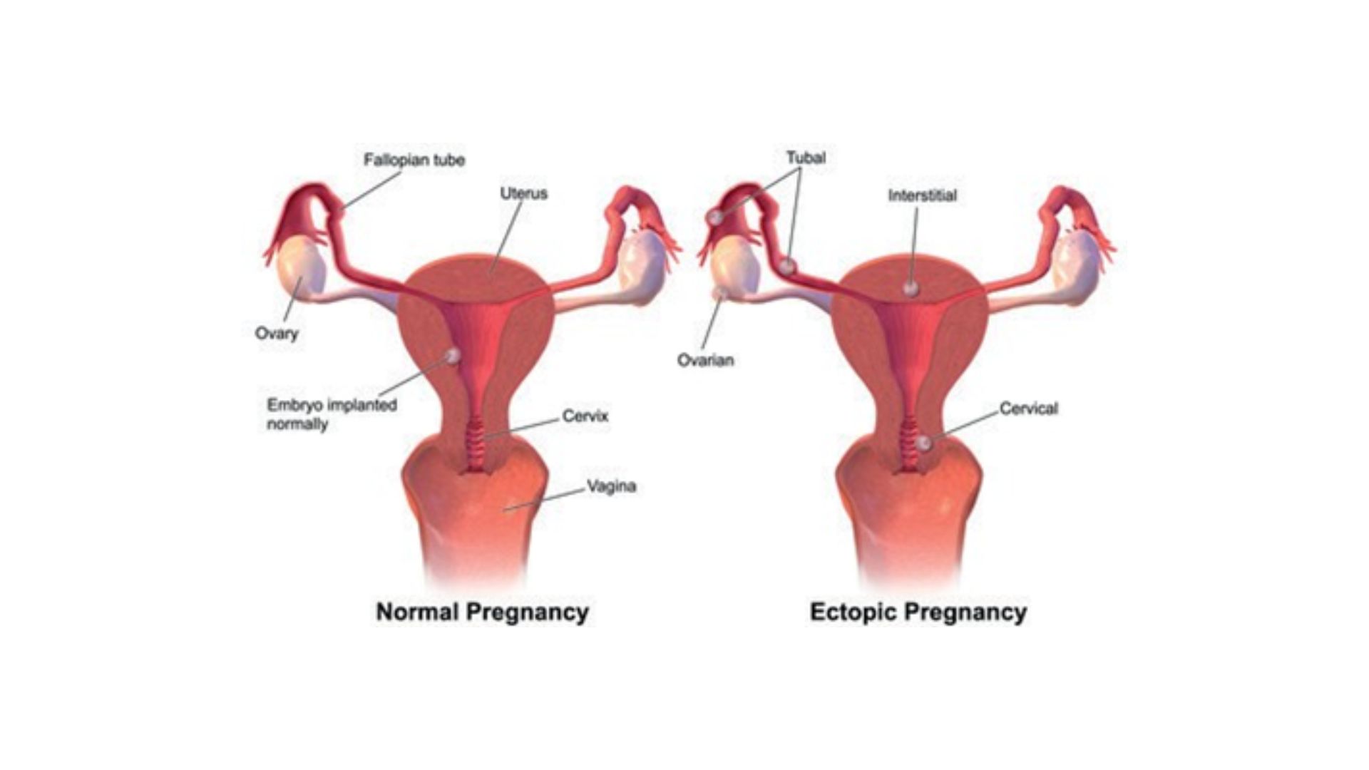 ectopic pregnancy graphic