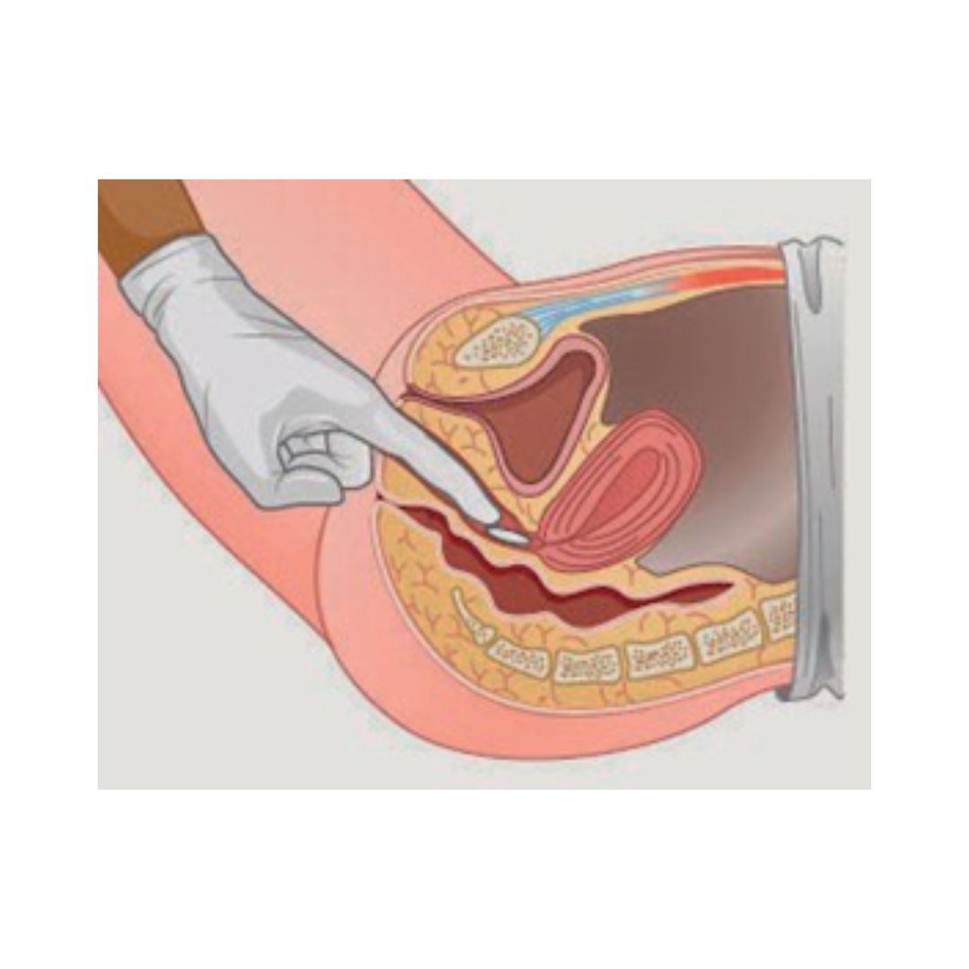 inserting abortion tablets vaginally